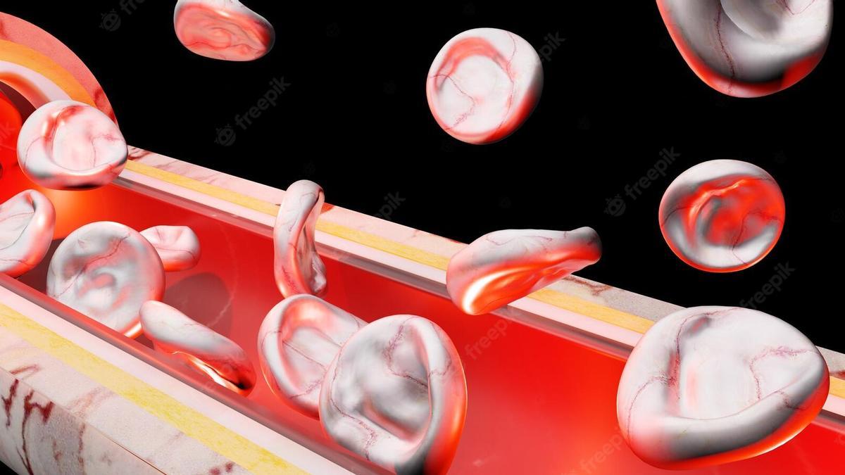 La vasculitis engloba un conjunto de enfermedades en la que la característica principal es la inflamación de los vasos sanguíneos.