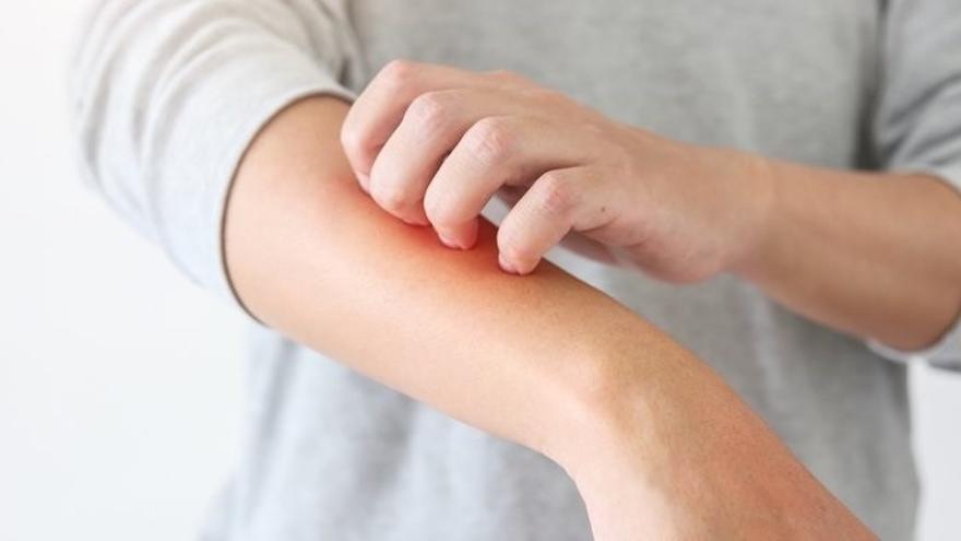 Los síntomas de la dermatitis atópica se agravan durante el otoño y el invierno