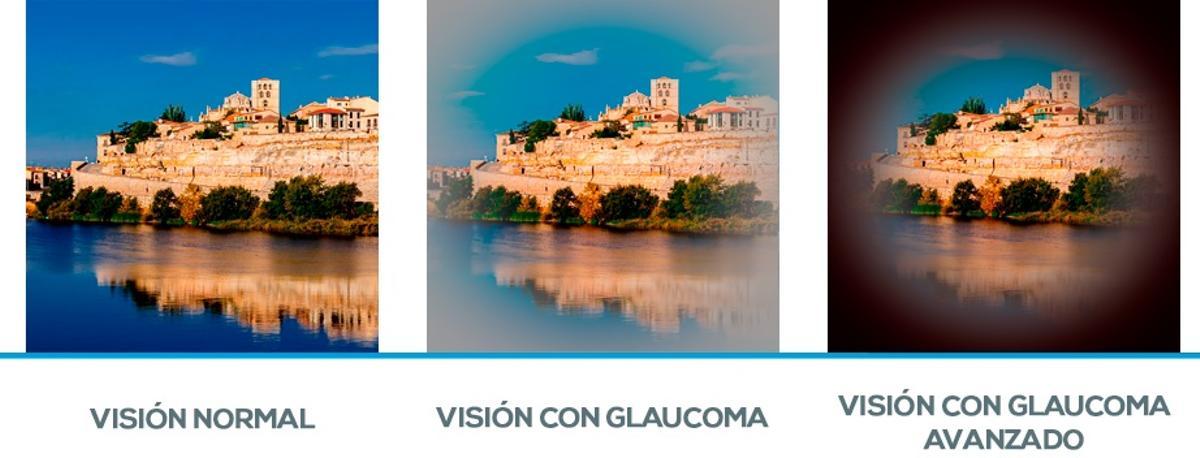 Simulación de la vista con glaucoma