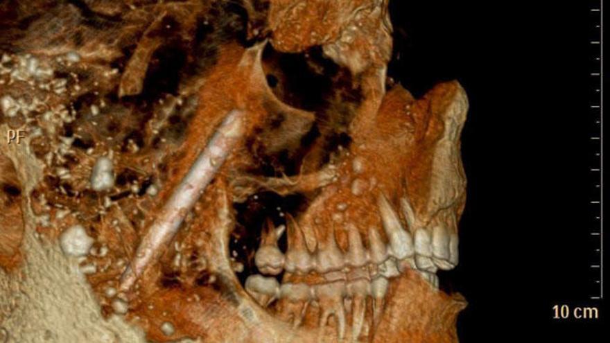 Los habitantes de Pompeya de hace 2.000 años tenían los dientes perfectos