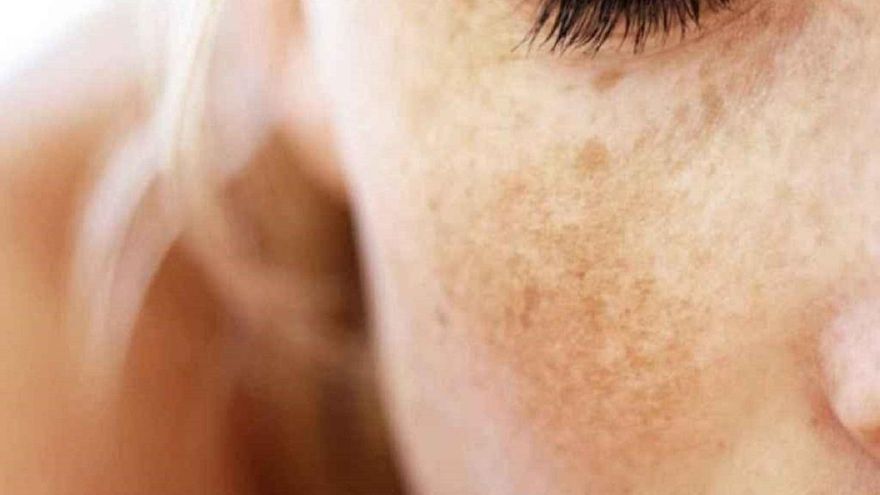 ¿Por qué salen manchas en la cara y cómo se pueden eliminar? ¿Cuáles son peligrosas?