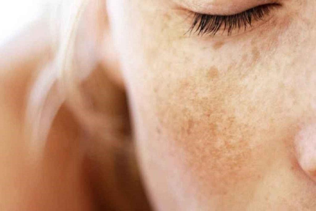 ¿Por qué salen manchas en la cara y cómo se pueden eliminar?