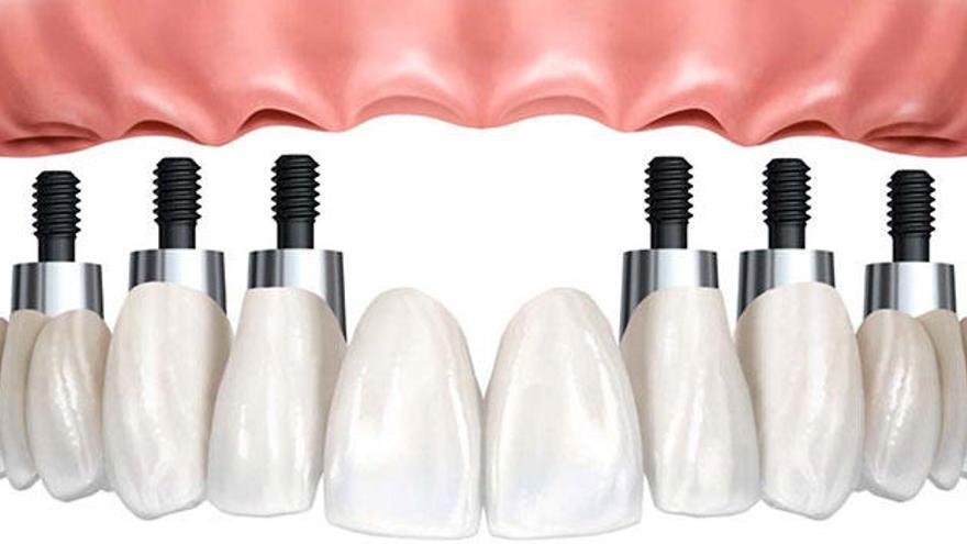 Implante y diente en un solo día: Empieza a sonreír
