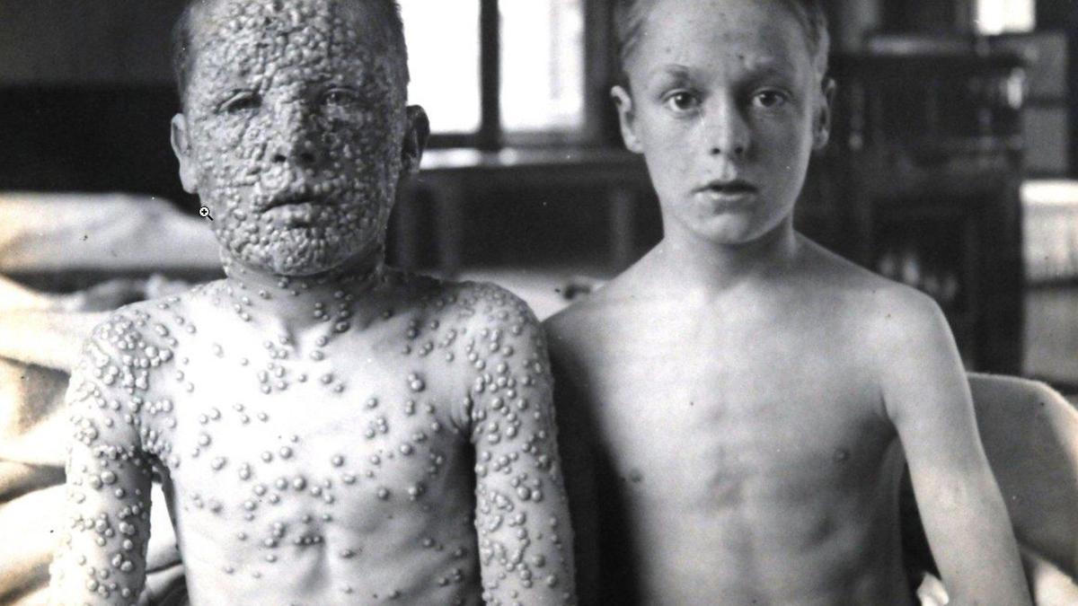 Una de las fotos que mejor reflejan el efecto de la vacuna. A la izquierda un niño sin vacunar, a la derecha otro que sí se inmunizó frente a la viruela humana