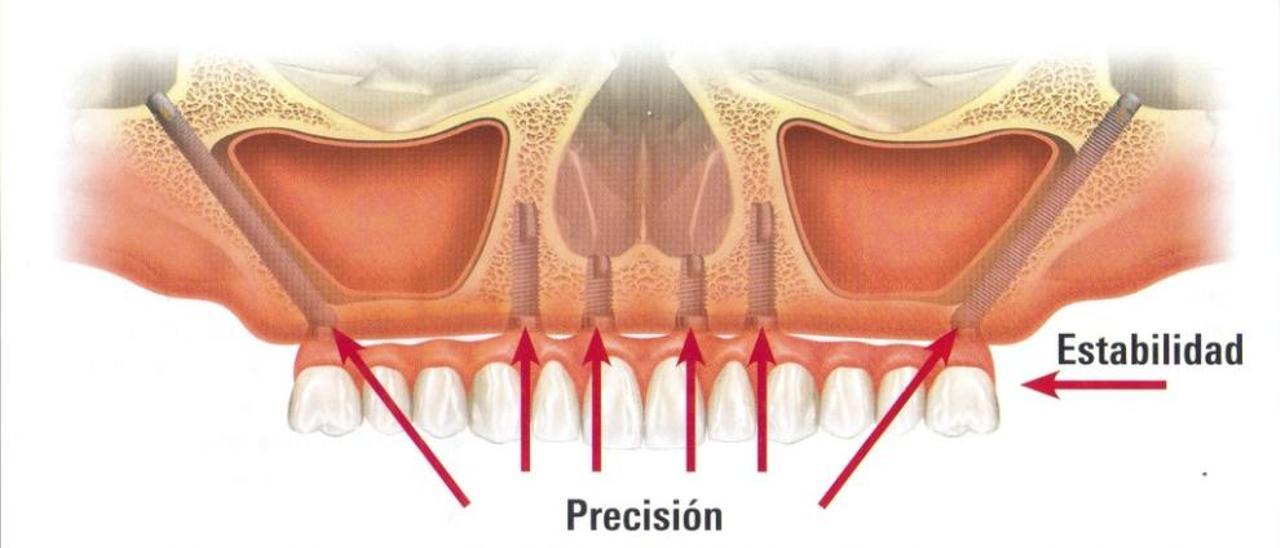 Reproducción de un implante zigomático, que se coloca en la dentadura superior.