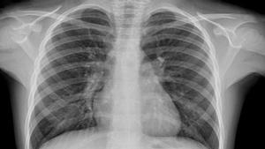 El daño pulmonar sigue estando presente un año después de pasar la neumonía por COVID-19