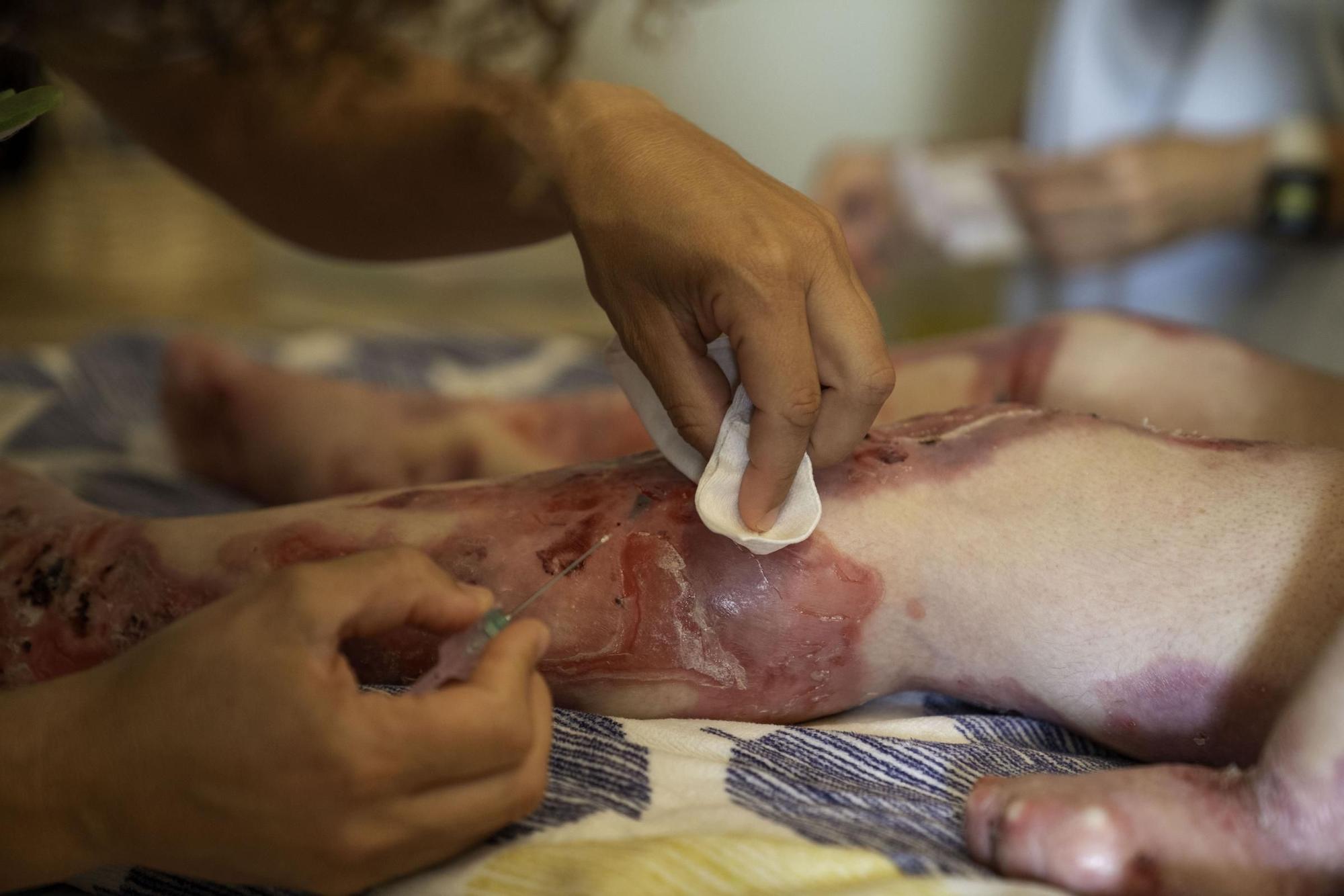 Vivir con piel de mariposa: "El dolor es insoportable"