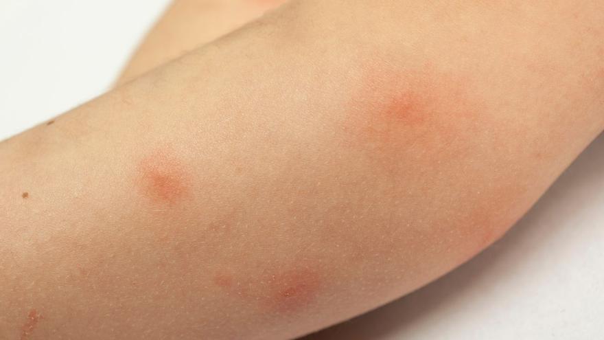 Picaduras de mosquitos: trucos Infalibles para aliviar el picor y detectar alergias