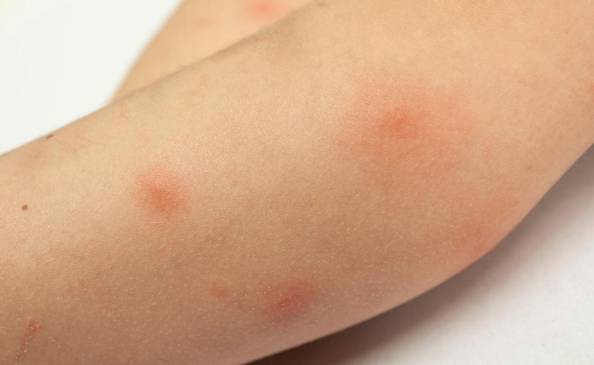 Picaduras de Mosquitos: Cómo Identificar Síntomas de Alergia y Aliviar el Picor de Forma Efectiva