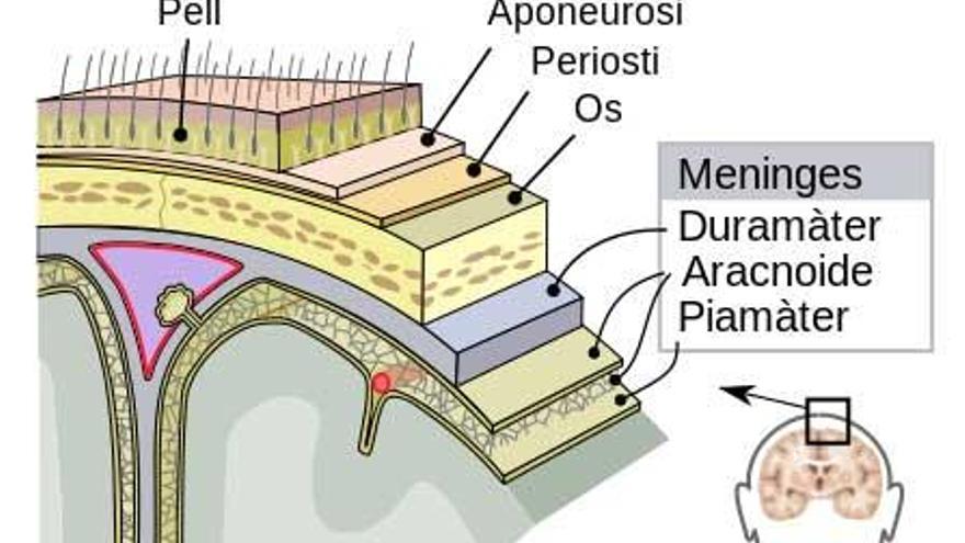 El gràfic mostra on afecta la meningitis.