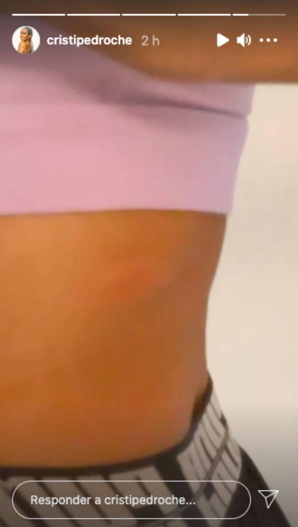 Cristina Pedroche enseña su picadura de abeja