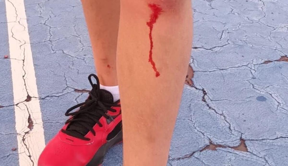 La rodilla de uno de los deportistas después de una caída mientras entrenaba