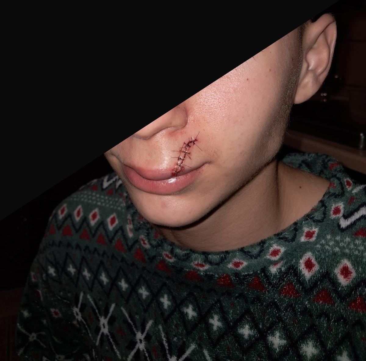 El cadete del Sant Jordi recibió varios puntos de sutura