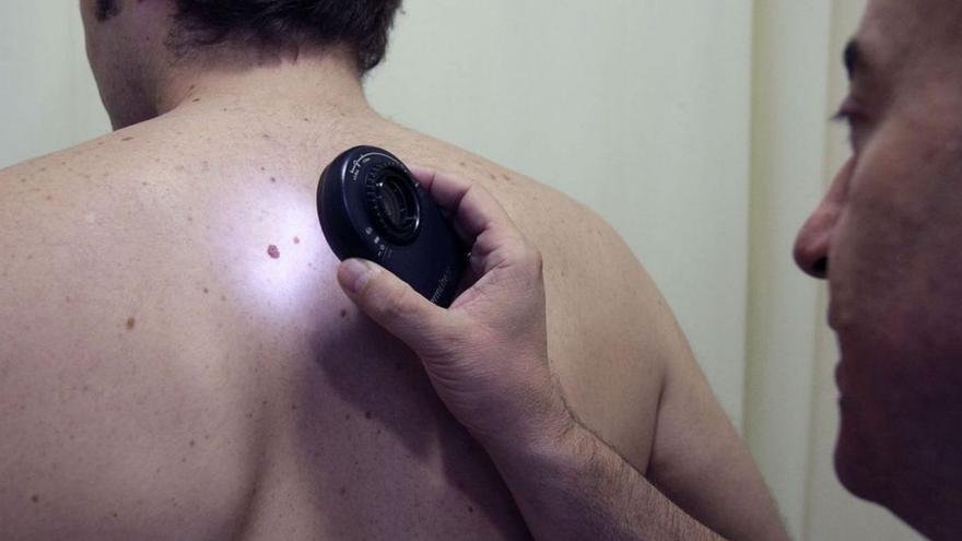 El cáncer de piel está entre los cinco tumores más prevalentes en Málaga