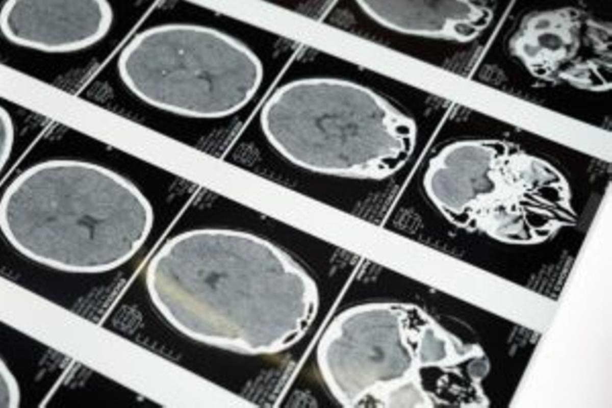 Consejos del neurólogo para mantener un cerebro sano