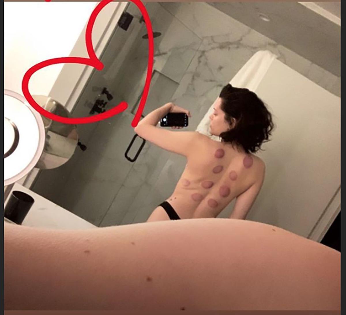 Jessie J con marcas en la espalda