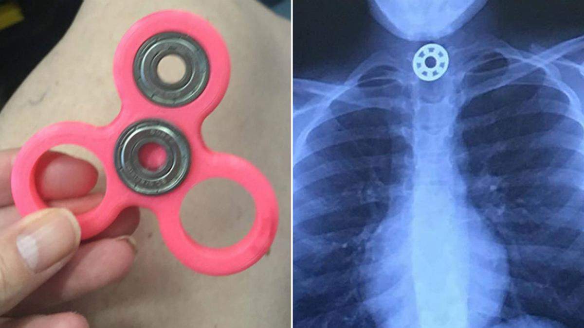 Una niña, intervenida de urgencia por asfixia al tragarse una pieza del Fidget Spinner