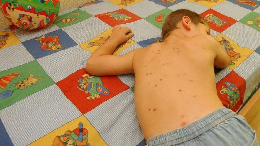 Aragón ya alcanza este año los casi 3.000 casos de varicela