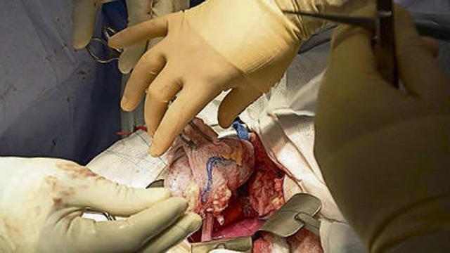 Médicos realizan un trasplante.