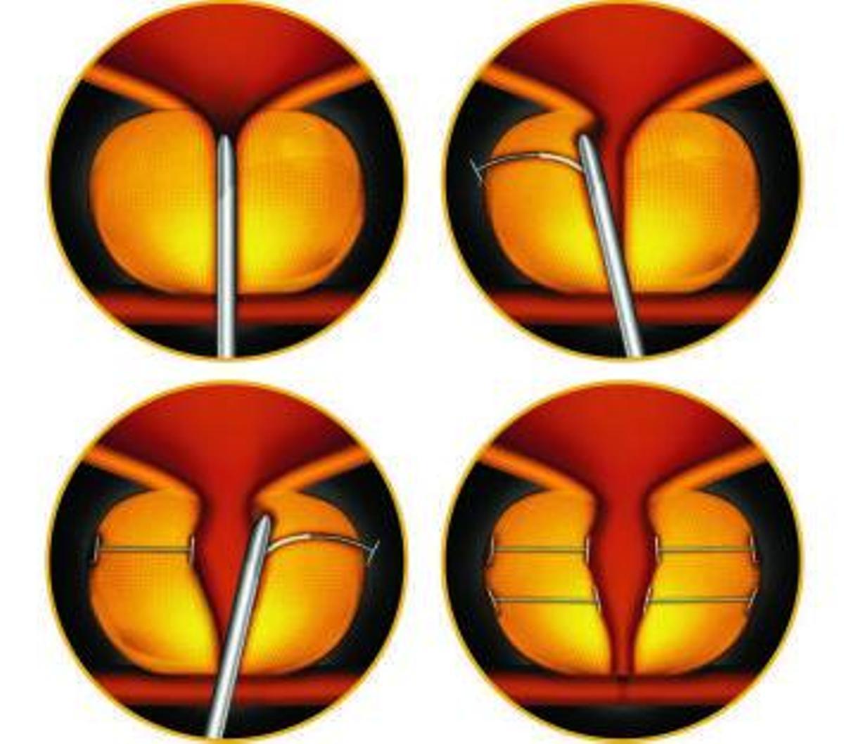 Cirugía con el sistema Urolift.