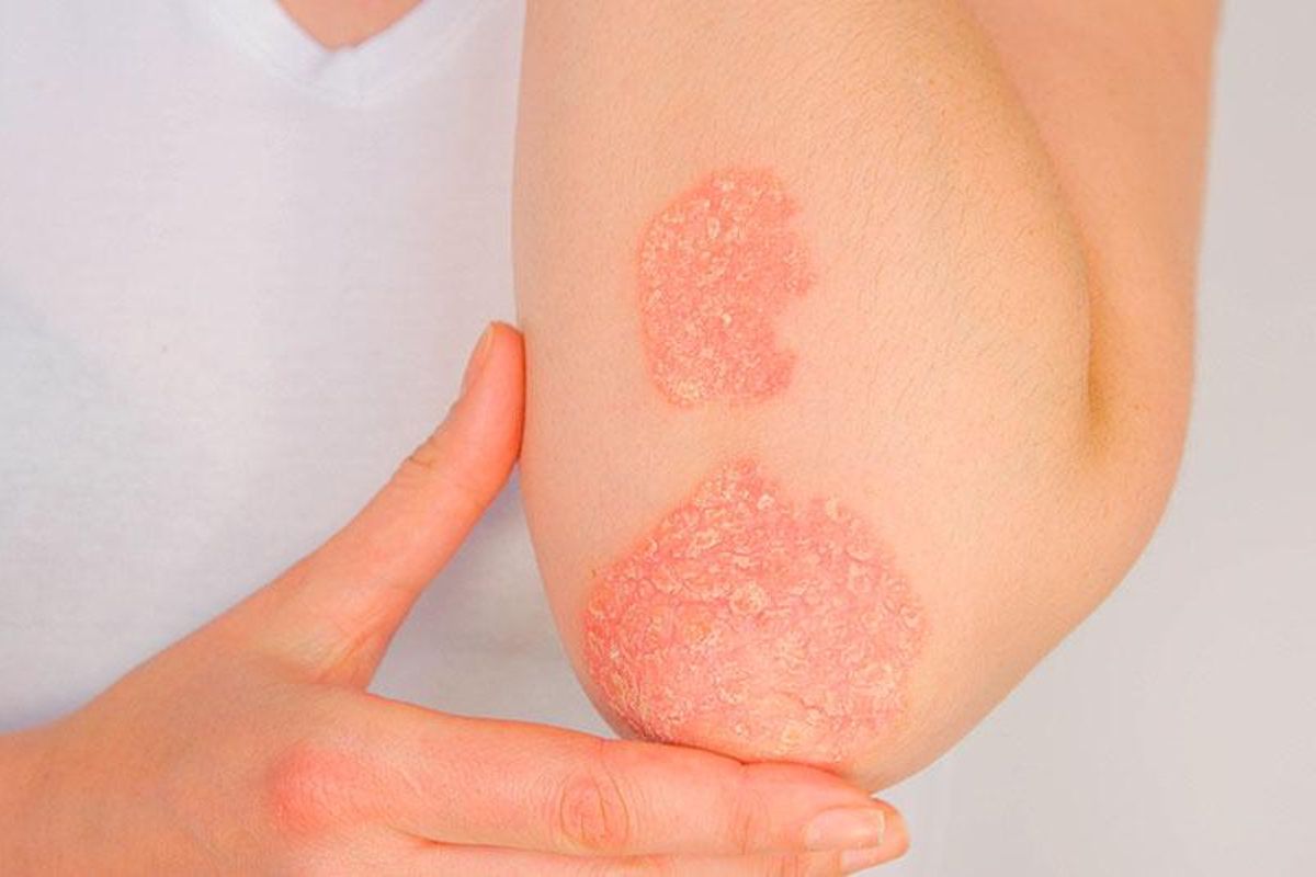El Día Mundial nos proporciona la oportunidad de recordar que la psoriais es mucho más que una enfermedad de la piel.