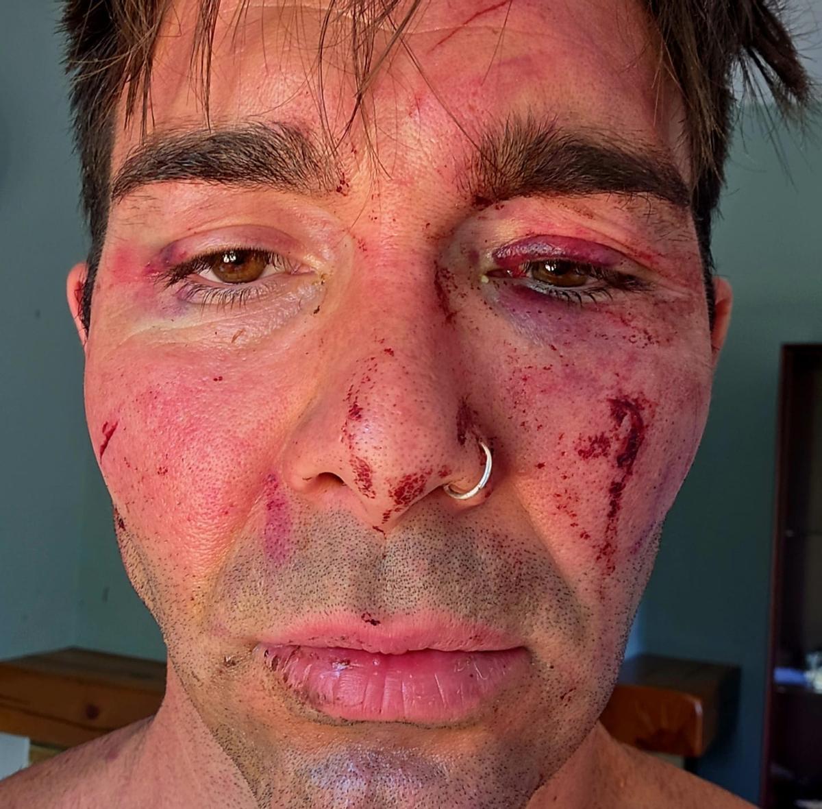 El taxista, con diversas heridas tras el atraco que asegura haber sufrido, en una imagen facilitada por él mismo.