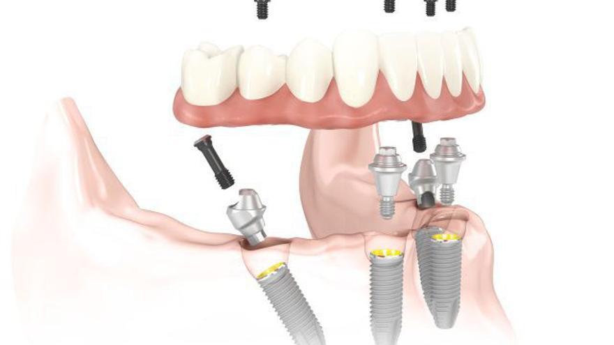 Los implantes “All -on-4” aplicables también en pacientes sin hueso, evitan al paciente tiempos de espera sin dientes.