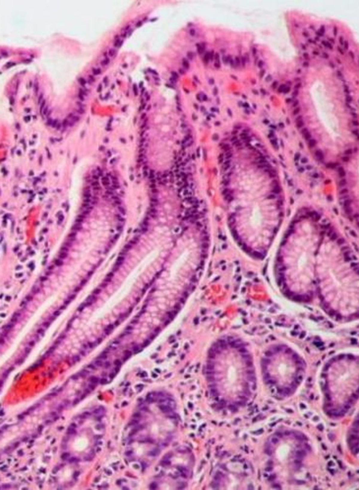 Un bacteri podria causar 12 milions de càncers gàstrics Un bacteri podria causar 12 milions de càncers gàstrics