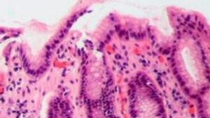 Un bacteri podria causar 12 milions  de càncers gàstrics
