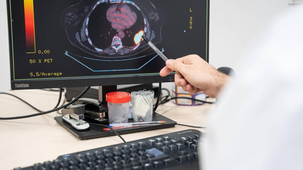 Un médico del ICO revisa la radiografía de los pulmones de un paciente con cáncer de pleura.