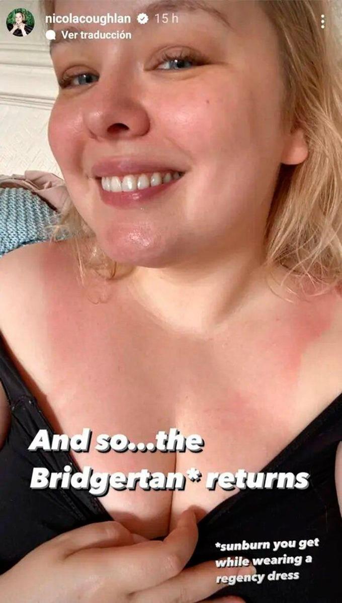 Nicola Coughlan enseña su quemadura