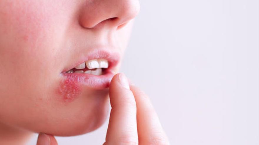 El herpes labial es una infección molesta