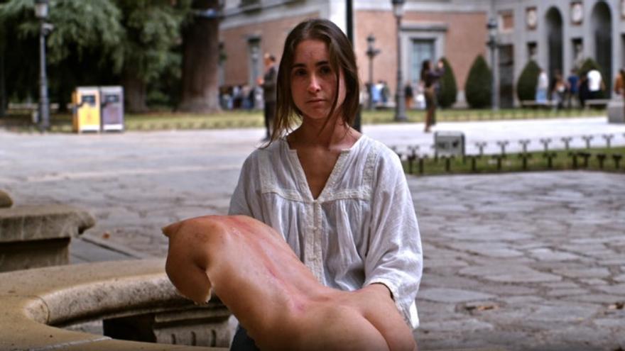 La dermatitis atópica grave impacta negativamente en la salud mental del paciente