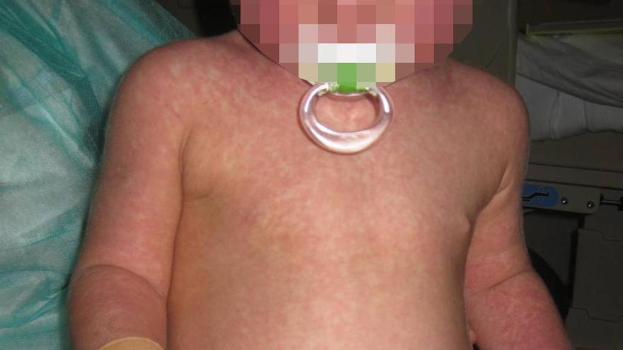 Un bebé canario con sarampión