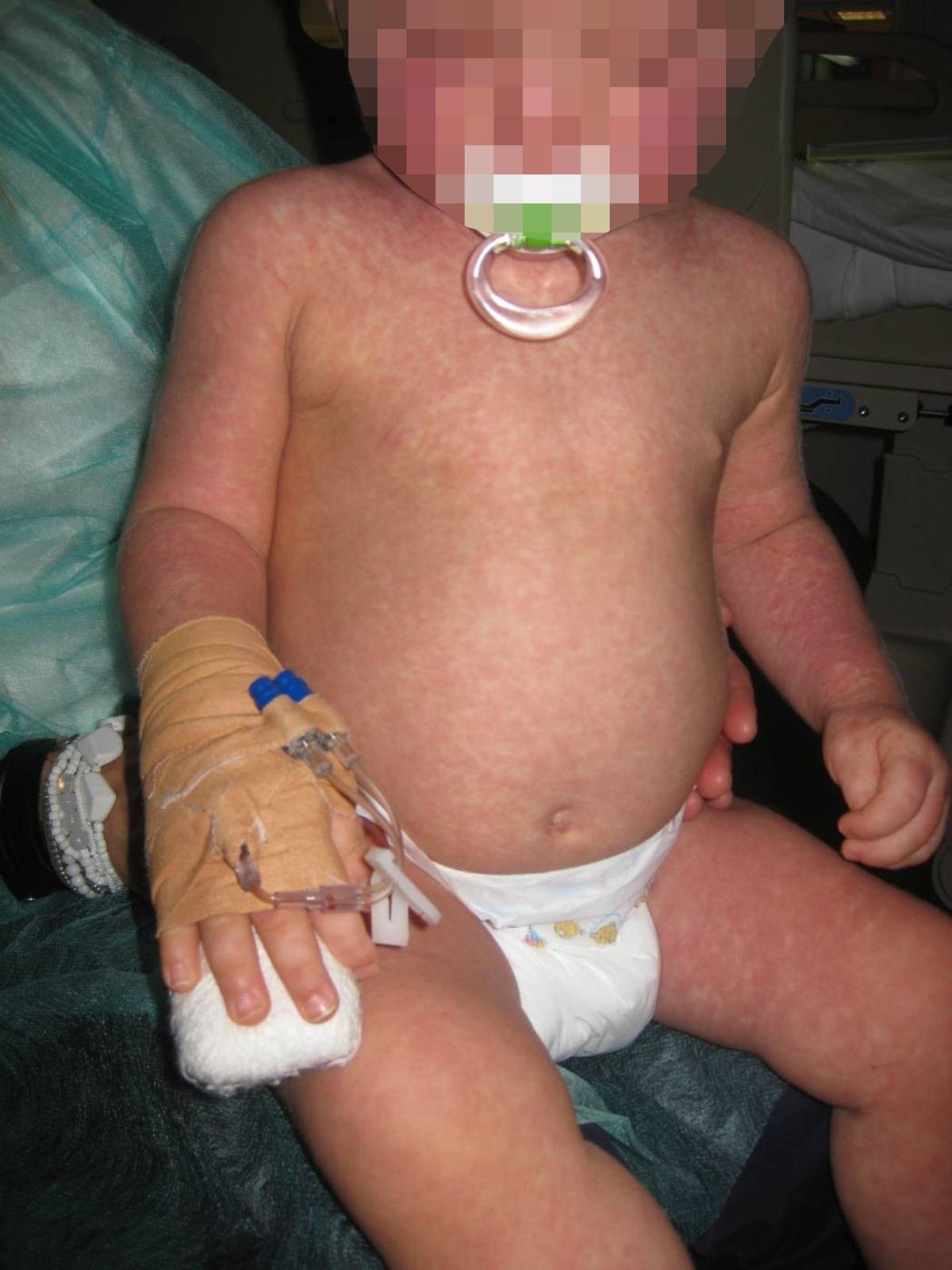 Un bebé canario con sarampión