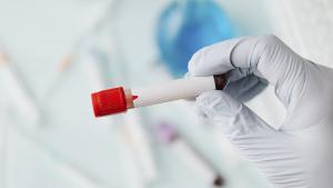 En una analítica, ¿qué significa tener los triglicéridos altos? ¿Qué hacer para bajarlos?