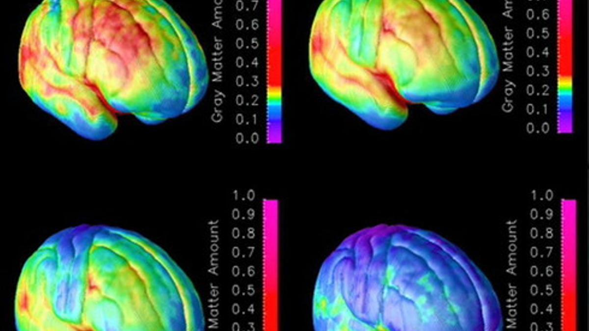 Combo de imágenes que muestran el proceso de maduración del cerebro.