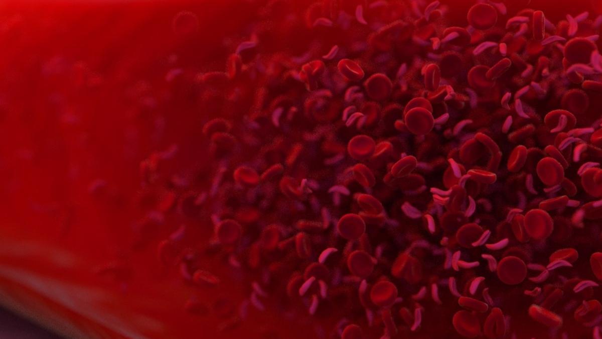 Anemia en la sangre en la que algunos de los glóbulos rojos tienen forma de media luna.