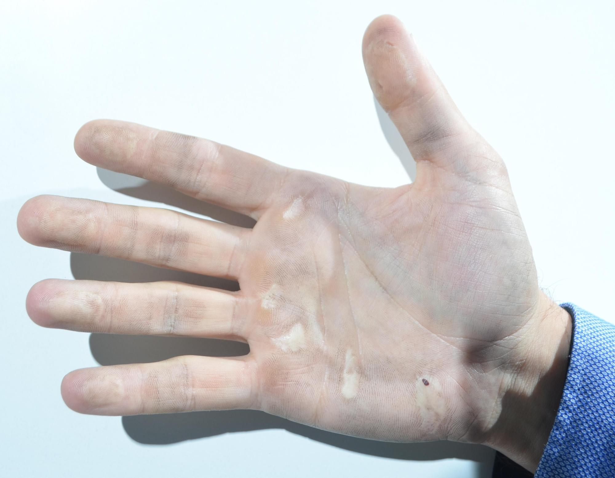 La mano de uno de los detenidos, con lesiones en los dedos. 