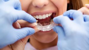 Ortodoncistas alertan del riesgo de comprar alineadores invisibles por internet.