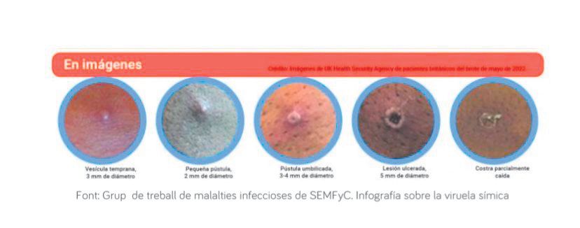 Evolución de las lesiones de viruela del mono