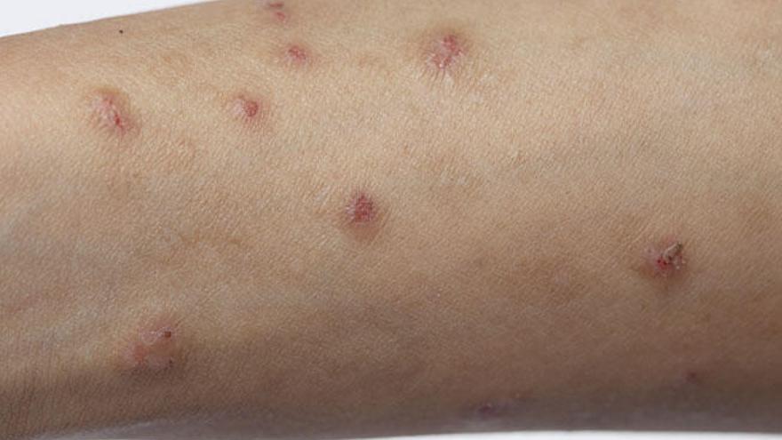 El herpes zóster es contagioso cuando aparecen las ampollas.