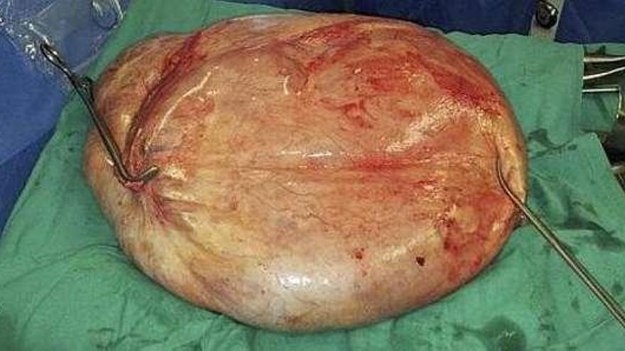 Extraído un tumor ovárico de 25 kilos a una mujer de 47 años en Alicante