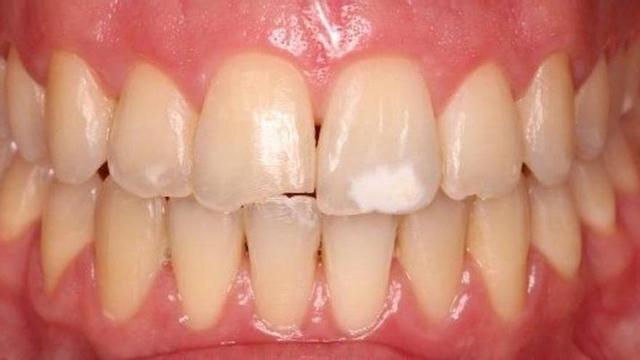Dents amb Hipoplasia dental.
