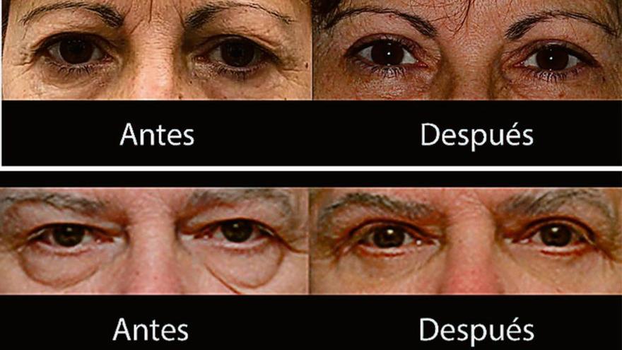 Blefaroplastia para una mirada joven y revitalizada