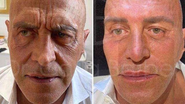 El antes y el después de Kiko Matamoros tras los retoques estéticos de Carla Barber.