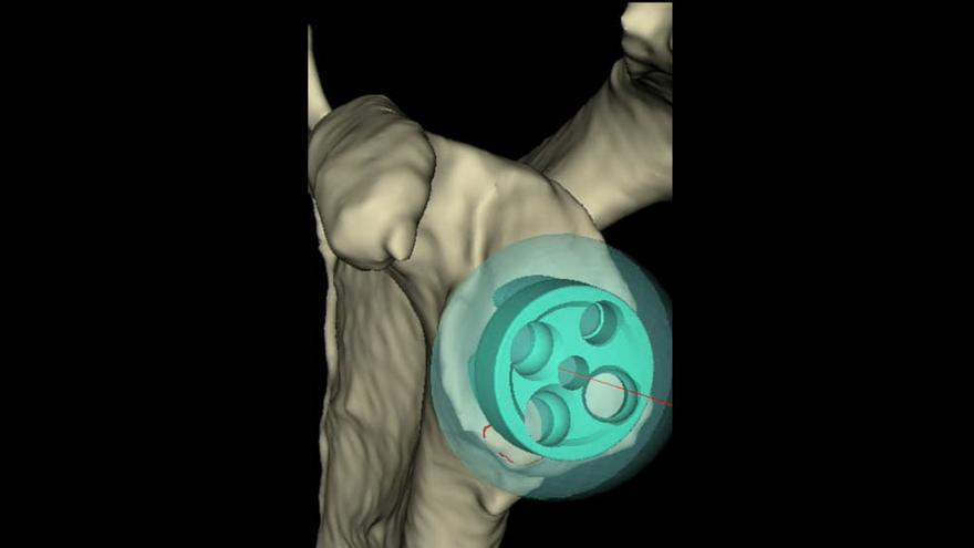 Planificación de una intervención de prótesis de hombro
