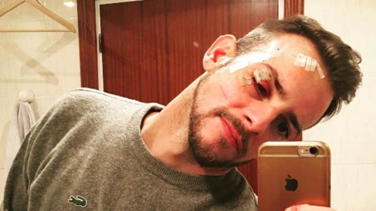 Àlex Casademunt muestra su rostro con múltiples heridas, tras sufrir una agresión el 15 de enero del 2017 en una discoteca de Vigo.