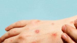Els dermatòlegs vigilen amb atenció la verola del mico