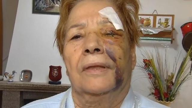 Feliciana muestra las heridas y mordeduras tras sufrir el ataque de cuatro perros en Muíños, hace dos años.